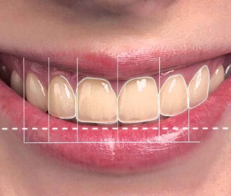estetica clinica dental castellon 1 - Estética dental