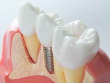 implantes dentales castellon clinica royo - Inicio