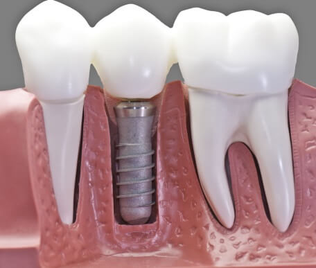 implantes dentales clinica dental castellon 1 - Implantes dentales