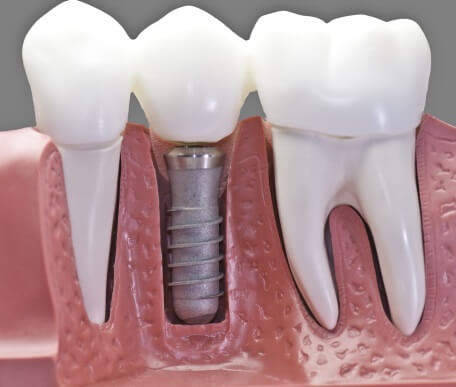 Clínica implantología dental