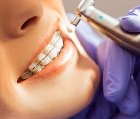 ortodoncia clinica dental castellon 1 - Ortodoncia