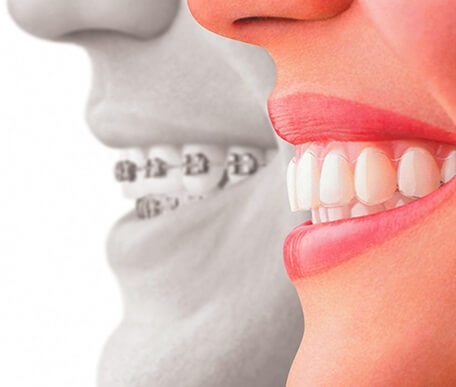 ortodoncia clinica dental castellon 2 - Ortodoncia