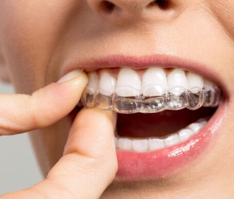 ortodoncia invisible invisalign clinica dental castellon 4 - Ortodoncia invisible