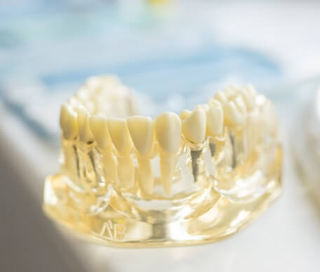 Clínica dental de Periodoncia en Castellón