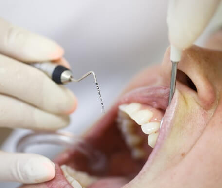 Periodoncia en Castellón