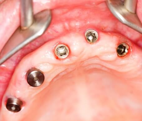 Implantes dentales en Castellón