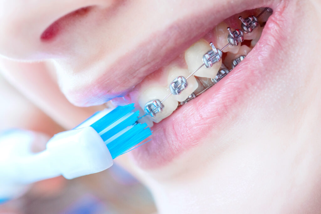 Cepillado de los dientes con brackets 1024x684 - Cómo cepillarse los dientes