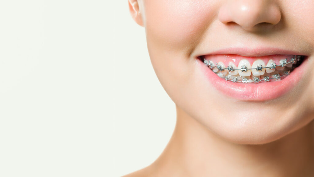 Ortodoncia brackets 1024x579 - Qué es una ortodoncia y qué tipos existen