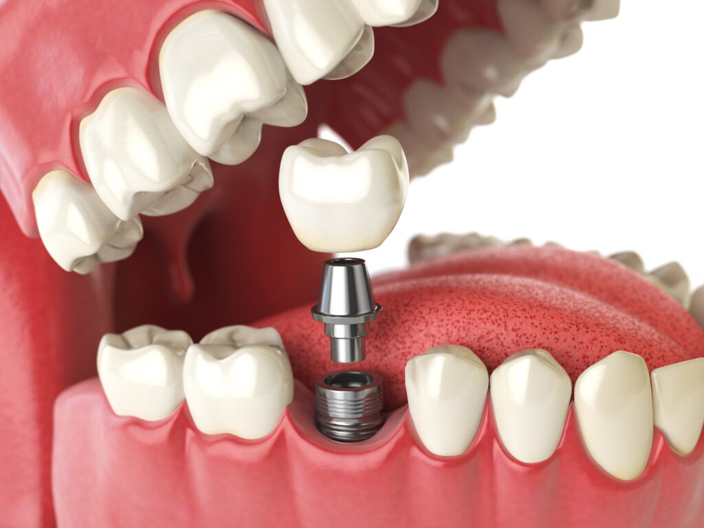 Partes de un implante 1024x768 - Descubre cuál es el precio de los implantes dentales