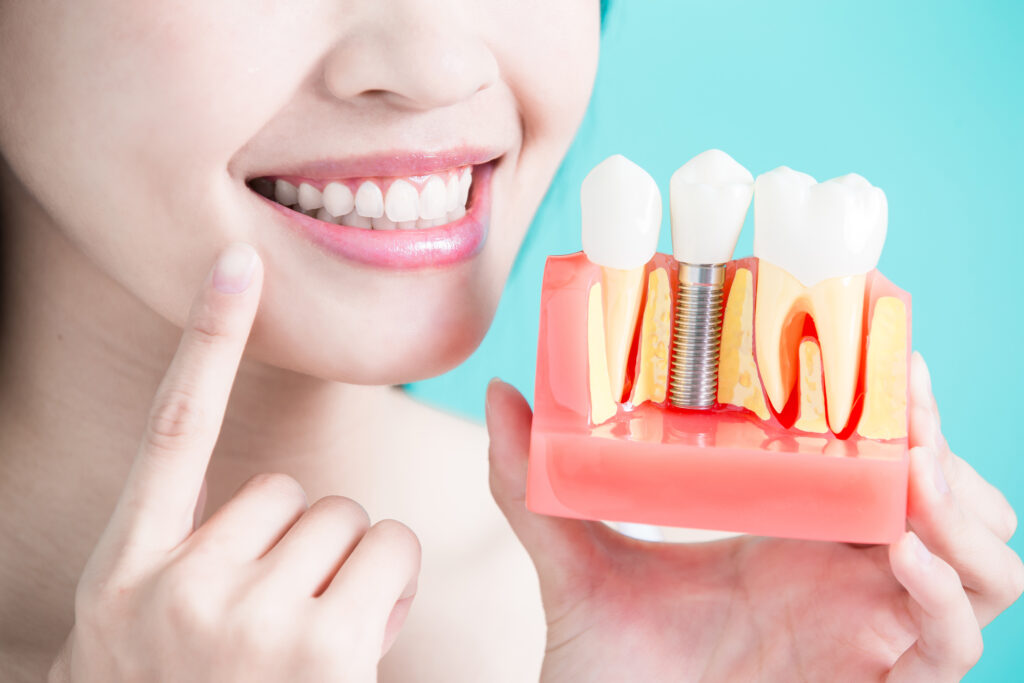 Precio implante en Castellon 1024x683 - Descubre cuál es el precio de los implantes dentales