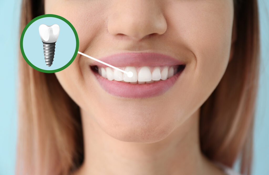 Precio implantes dentales 1024x667 - Descubre cuál es el precio de los implantes dentales