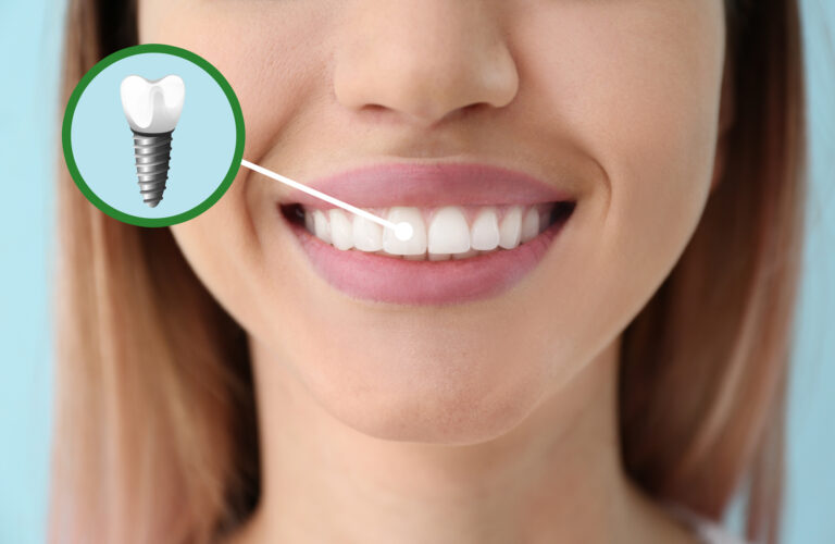 Precio implantes dentales 768x500 - Blog