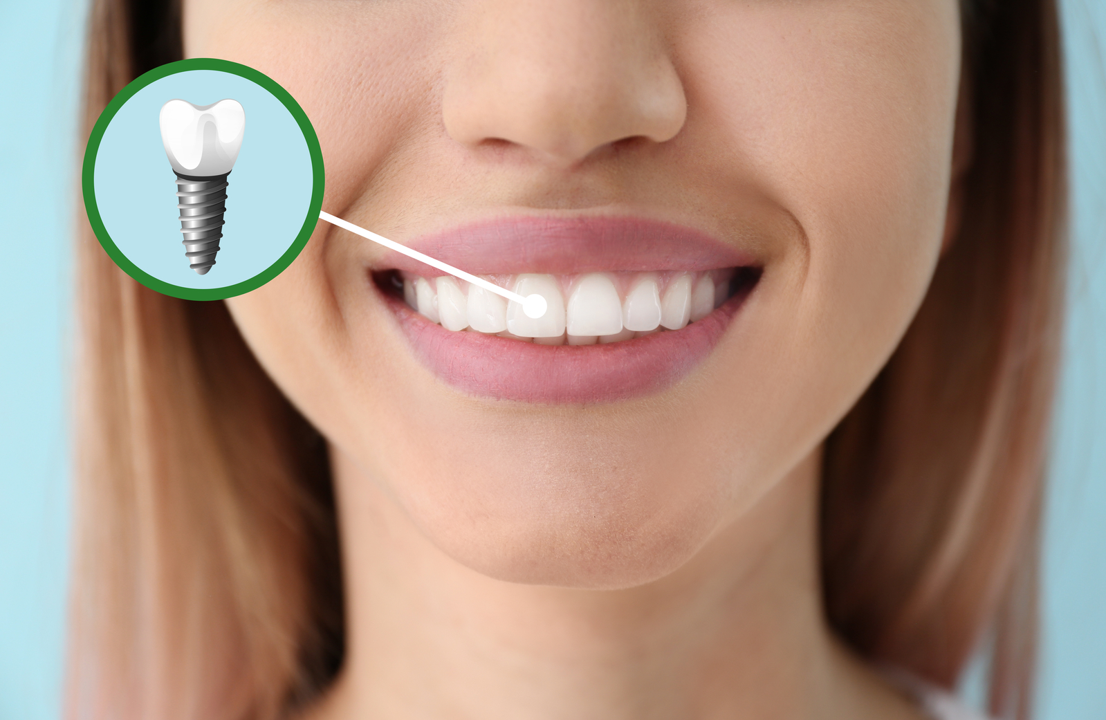 Descubre cuál es el precio de los implantes dentales [Año 2023]