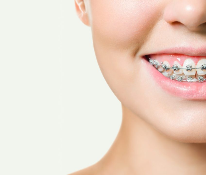 Brackets para adultos Castellón